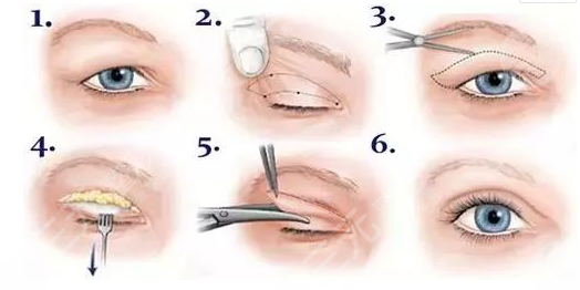 西京医院双眼皮后