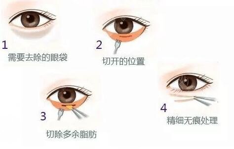 成都八大处祛眼袋真实案例果图:术前