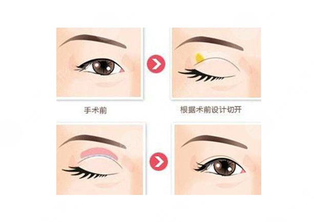 湘潭市中心医院整形科双眼皮案例