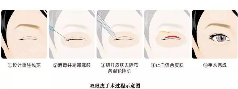 2025年华西美容科收费标准，附有漂亮的双眼皮案例！