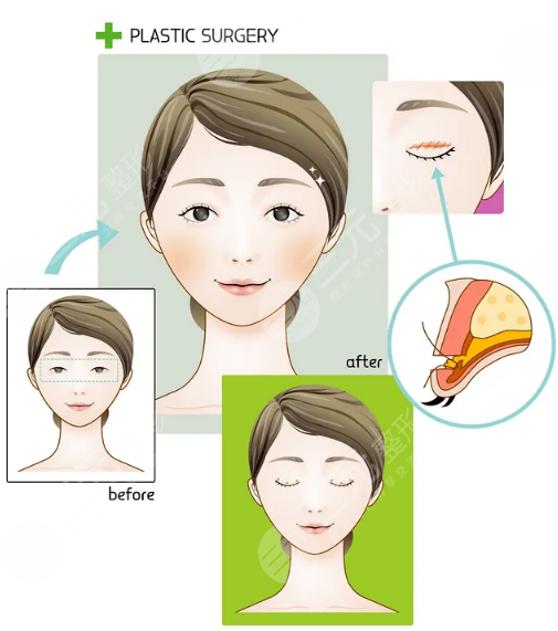 双眼皮切割手术案例
