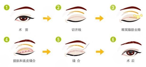 什么是双眼皮切割手术