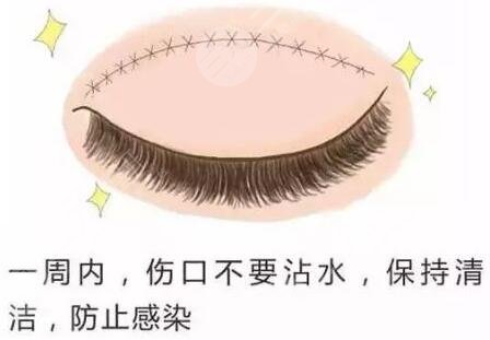 双眼皮切割手术后注意事项