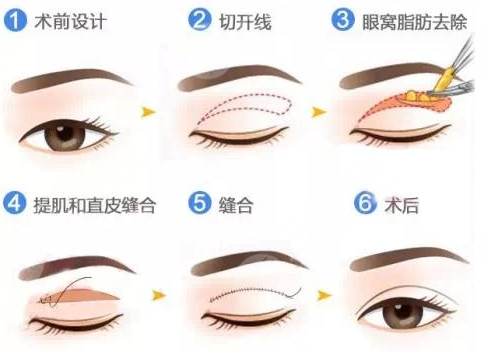 沈阳陆军总院割双眼皮去眼袋的详细价格表出来啦！