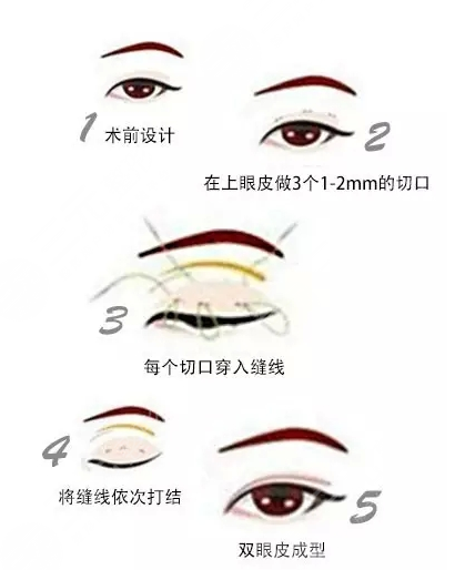 双眼皮手术前