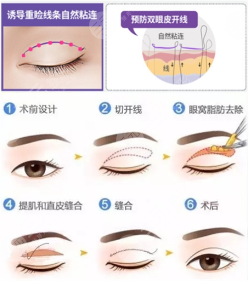双眼皮手术中