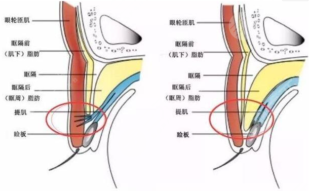 双眼皮手术后