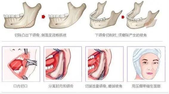 磨颧骨整形手术价格影响因素