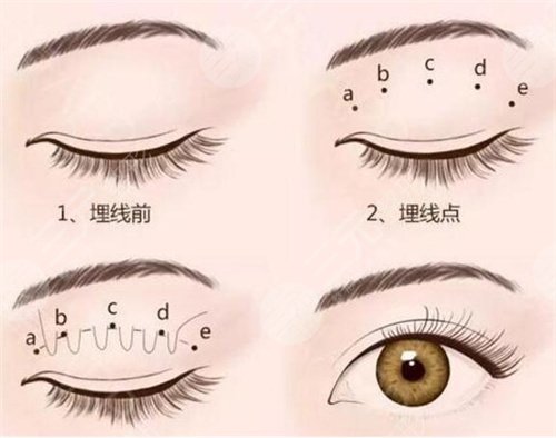 南昌二附医院双眼皮案例