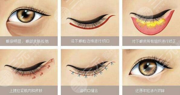 八大处整形去眼袋案例