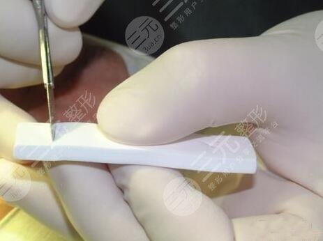 厦门中医院整形科隆鼻案例