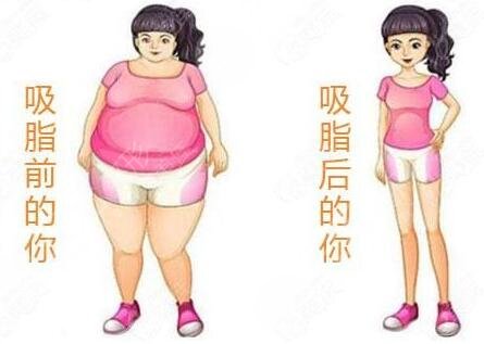 苏州市立医院腹部抽脂案例
