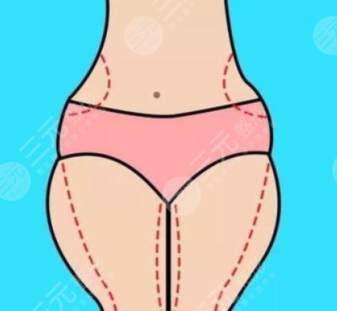 南方医科大学南方医院整形科腹部抽脂案例