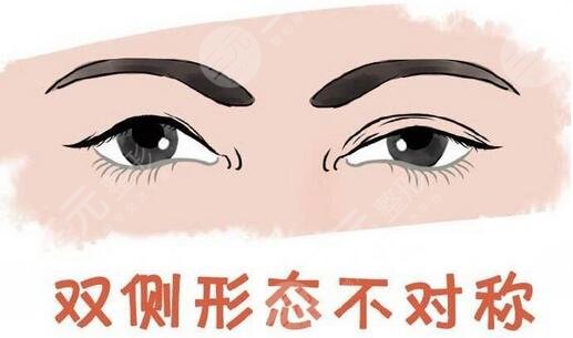 华西医院整形科李正勇双眼皮案例：术前