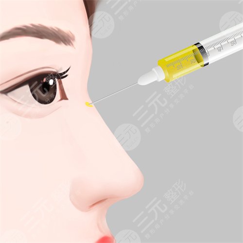 秦皇岛中医院医疗美容科隆鼻案例