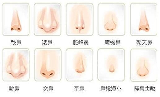 硅胶隆鼻术后一周