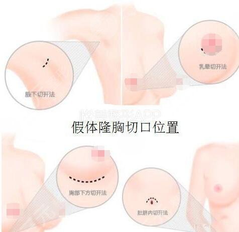 上海九院假体隆胸案例