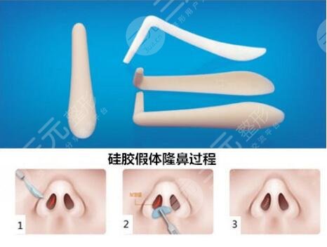 隆鼻手术的成功案例