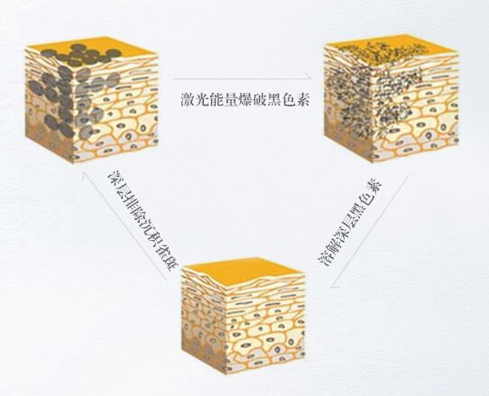 嘉兴曙光医院科普激光祛斑