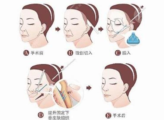 深圳拉皮手术多少钱