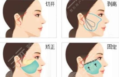 影响深圳拉皮手术价格的因素