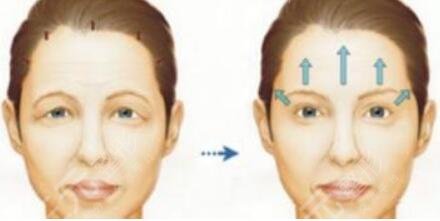 拉皮手术果怎么样