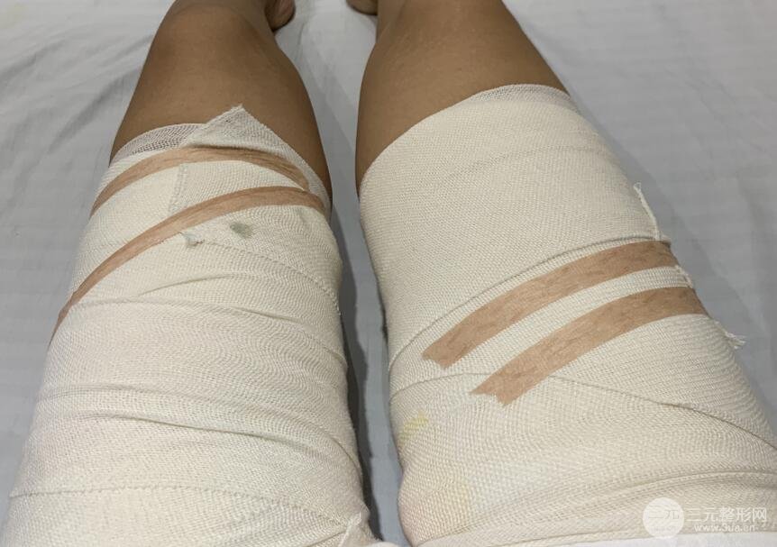 大腿吸脂案例