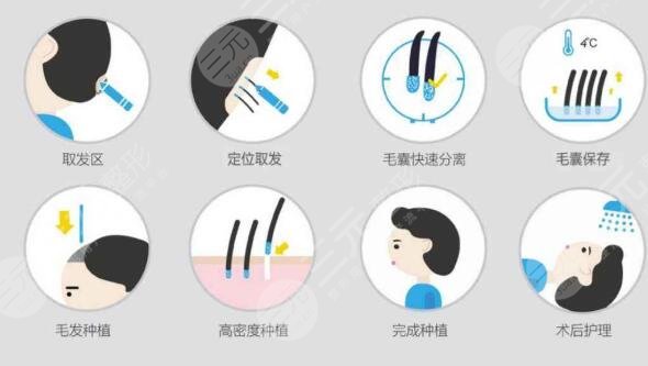 植发的注意事项