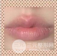 厚唇改薄案例