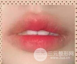 厚唇改薄案例