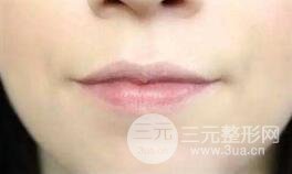 丰唇对比图