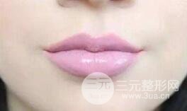 丰唇对比图
