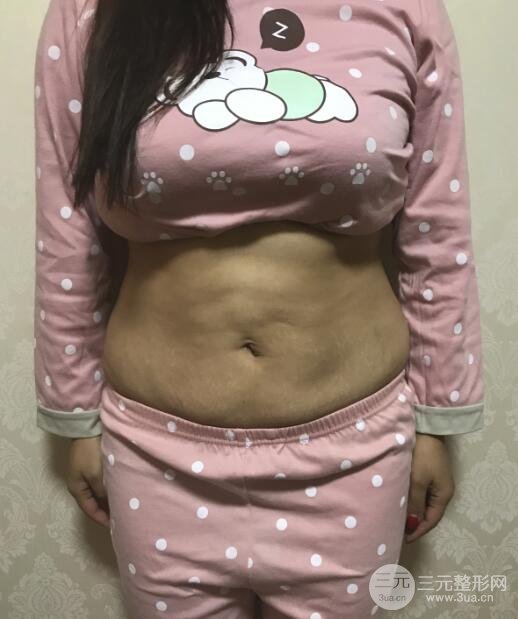 九院抽脂案例