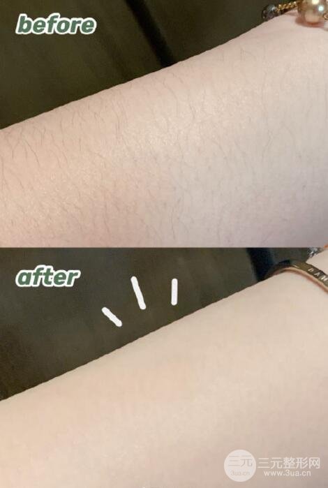 手臂脱毛