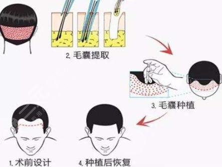 北京八大处整形医院植发项目科普：