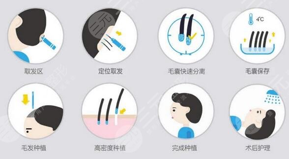 植发技术能够保持多久?