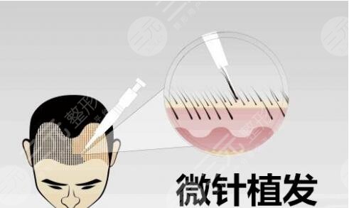 植发技术需要多长时间?