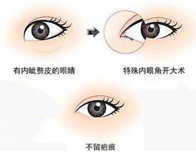 开外眼角术价格一般是多少?
