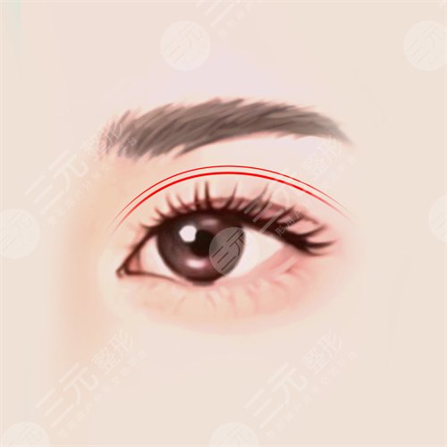 开外眼角案例后