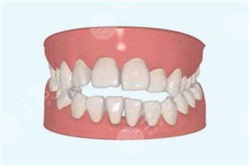 佛山向阳口腔牙齿矫正案例前