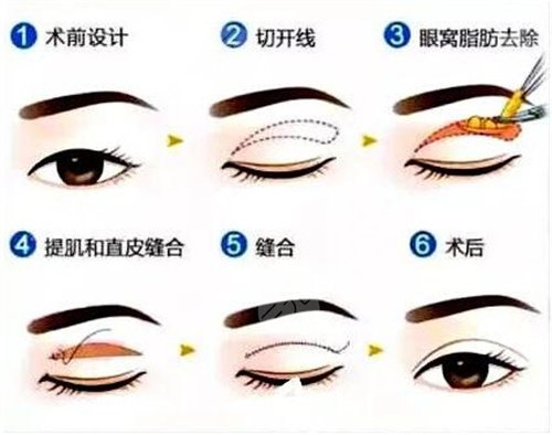 武汉同济医院整形美容外科去眼袋案例前