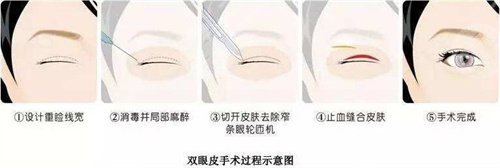 武汉同济医院整形美容外科去眼袋案例后