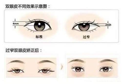 江门中心医院整形科双眼皮案例前