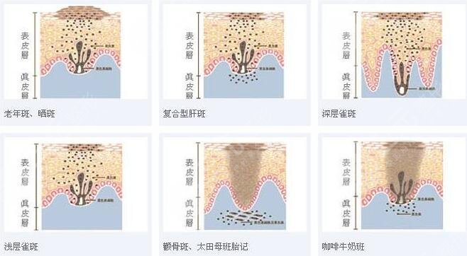 许昌市中心医院整形科激光祛斑果图