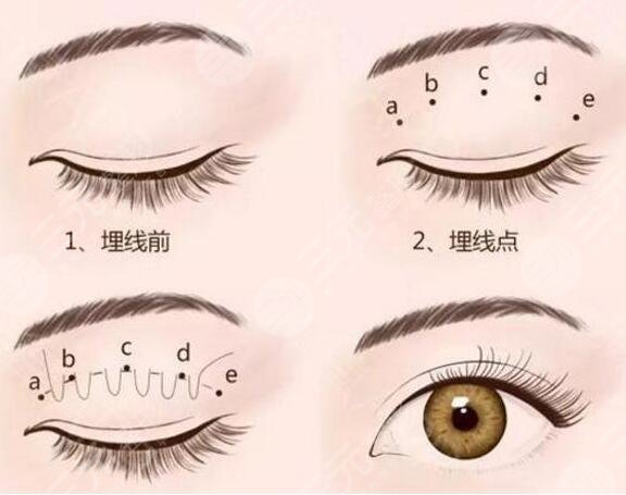湘雅附二医院美容科双眼皮案例图