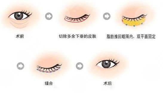 长沙湘雅医院割眼袋案例,10年熬出来的眼袋这样消灭它…