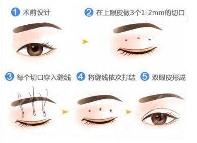 菏泽市立医院整形美容科双眼皮案例