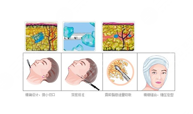 北京佰华利医美面部吸脂案例