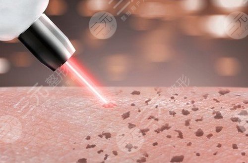 四川省人民医院整形美容科祛斑案例