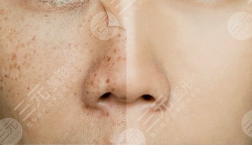 四川省人民医院整形美容科祛斑案例